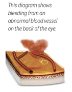 This diagram shows bleeding from on abnormal blood vessel on the back of the eye.