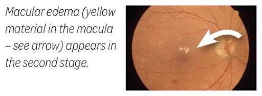 Macular edema (yellow material in the macula – see arrow) appears in the second stage.